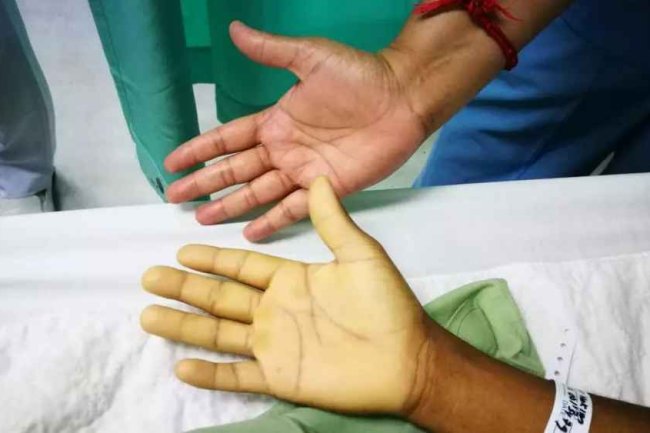 एनीमिया