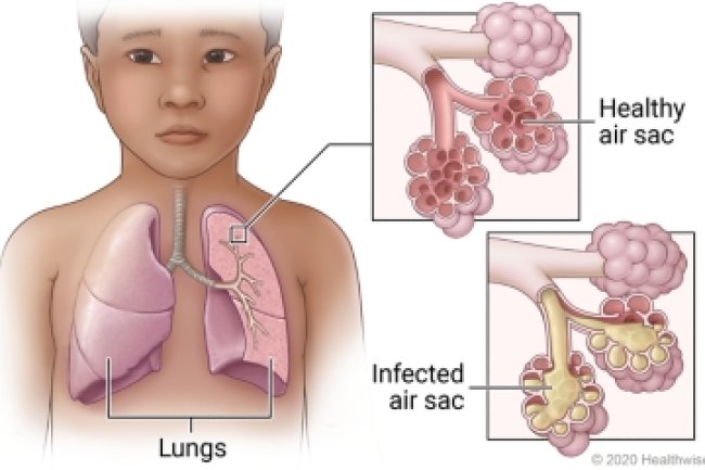 Pneumonia (निमोनिया)