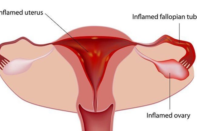 कष्टार्तव (दर्दयुक्त महामारी ) Dysmenorrhea (painful menorrhagia)