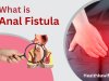 Fistula भगंदर