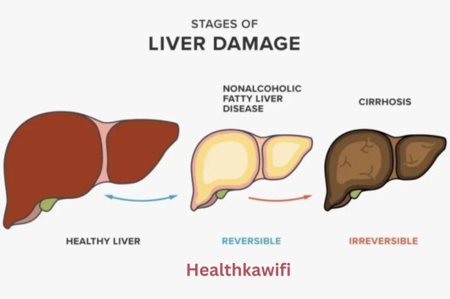 Liver disease यकृत रोग