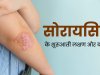सोरायसिस के कारण, लक्षण और उपचार | Psoriasis In Hindi