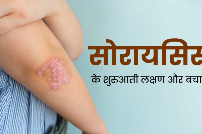 सोरायसिस के कारण, लक्षण और उपचार | Psoriasis In Hindi