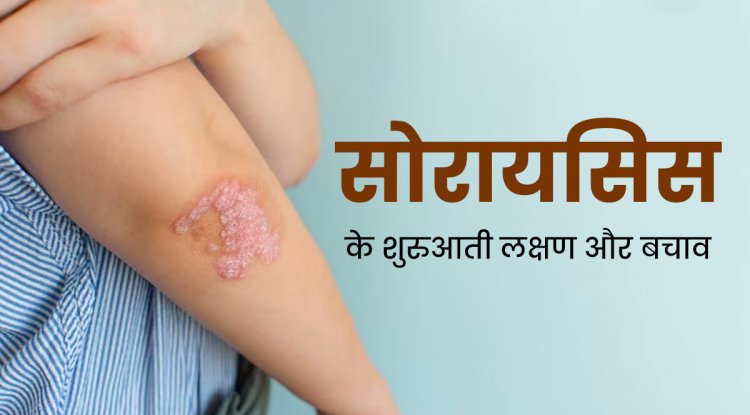 सोरायसिस के कारण, लक्षण और उपचार | Psoriasis In Hindi